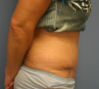 Body Contouring  Case 201 - Tummy Tuck