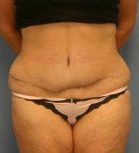 Body Contouring  Case 211 - Tummy Tuck