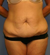 Body Contouring  Case 211 - Tummy Tuck