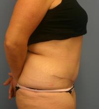 Body Contouring  Case 211 - Tummy Tuck