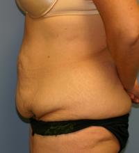 Body Contouring  Case 211 - Tummy Tuck