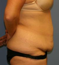 Body Contouring  Case 211 - Tummy Tuck