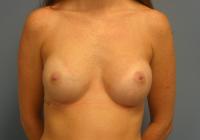 Breast Surgery  Case 221 - Breast Augmentation