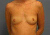 Breast Surgery  Case 221 - Breast Augmentation