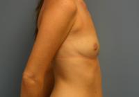 Breast Surgery  Case 221 - Breast Augmentation