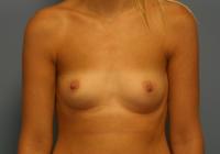 Breast Surgery  Case 231 - Breast Augmentation