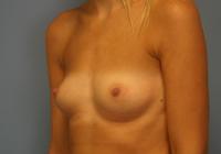 Breast Surgery  Case 231 - Breast Augmentation