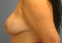 Breast Surgery  Case 241 - Breast Reduction