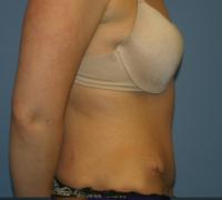 Body Contouring  Case 251 - Tummy Tuck