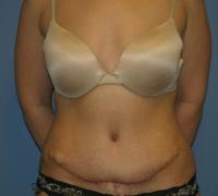 Body Contouring  Case 251 - Tummy Tuck