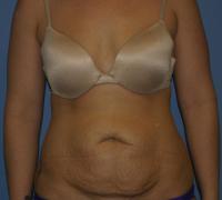 Body Contouring  Case 251 - Tummy Tuck