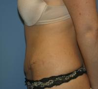 Body Contouring  Case 251 - Tummy Tuck