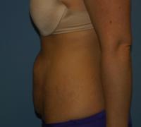 Body Contouring  Case 251 - Tummy Tuck