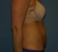 Body Contouring  Case 251 - Tummy Tuck