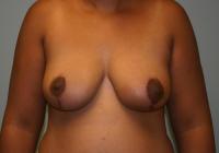 Breast Surgery  Case 271 - Breast Reduction