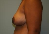 Breast Surgery  Case 271 - Breast Reduction