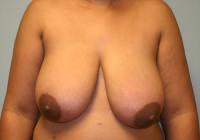 Breast Surgery  Case 271 - Breast Reduction