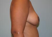 Breast Surgery  Case 271 - Breast Reduction