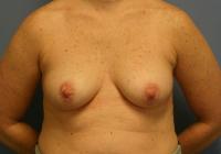 Breast Surgery  Case 311 - Breast Augmentation