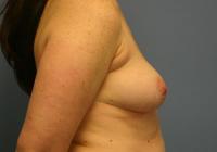 Breast Surgery  Case 311 - Breast Augmentation