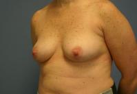 Breast Surgery  Case 311 - Breast Augmentation