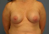 Breast Surgery  Case 311 - Breast Augmentation