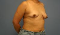 Breast Surgery  Case 331 - Breast Augmentation