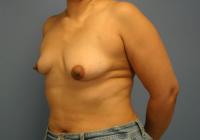 Breast Surgery  Case 331 - Breast Augmentation