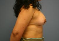 Breast Surgery  Case 331 - Breast Augmentation