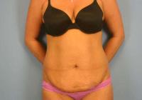 Body Contouring  Case 351 - Tummy Tuck