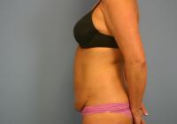 Body Contouring  Case 351 - Tummy Tuck