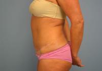 Body Contouring  Case 351 - Tummy Tuck