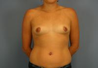 Breast Surgery  Case 361 - Breast Augmentation