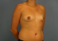 Breast Surgery  Case 361 - Breast Augmentation