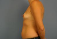 Breast Surgery  Case 361 - Breast Augmentation