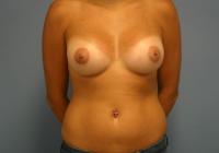 Breast Surgery  Case 361 - Breast Augmentation