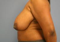 Breast Surgery  Case 371 - Breast Reduction