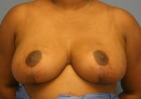 Breast Surgery  Case 371 - Breast Reduction