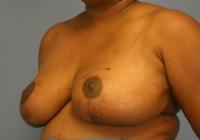 Breast Surgery  Case 371 - Breast Reduction