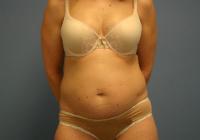 Body Contouring  Case 401 - Tummy Tuck