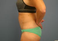 Body Contouring  Case 401 - Tummy Tuck