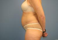 Body Contouring  Case 401 - Tummy Tuck