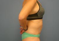 Body Contouring  Case 401 - Tummy Tuck