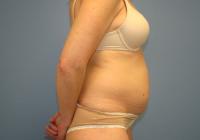 Body Contouring  Case 401 - Tummy Tuck