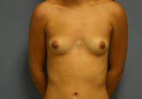 Breast Surgery  Case 421 - Breast Augmentation