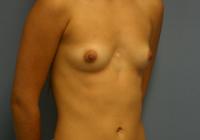 Breast Surgery  Case 421 - Breast Augmentation