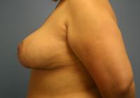 Breast Surgery  Case 431 - Breast Reduction