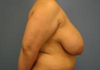 Breast Surgery  Case 431 - Breast Reduction