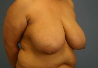 Breast Surgery  Case 431 - Breast Reduction