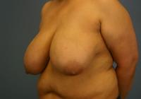 Breast Surgery  Case 431 - Breast Reduction